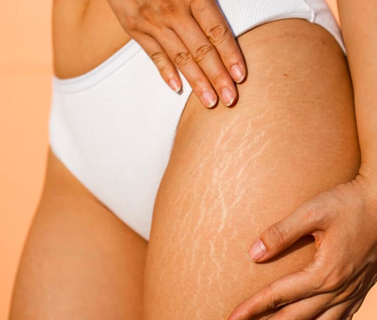 Laser Treatment For Stretch Marks In Paris Skin Marceau Clinic