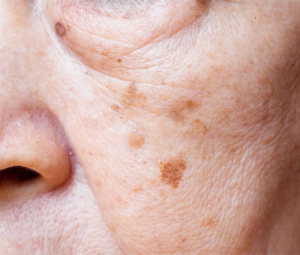 Brown Spots Causes And Treatments Skin Marceau Clinic Paris