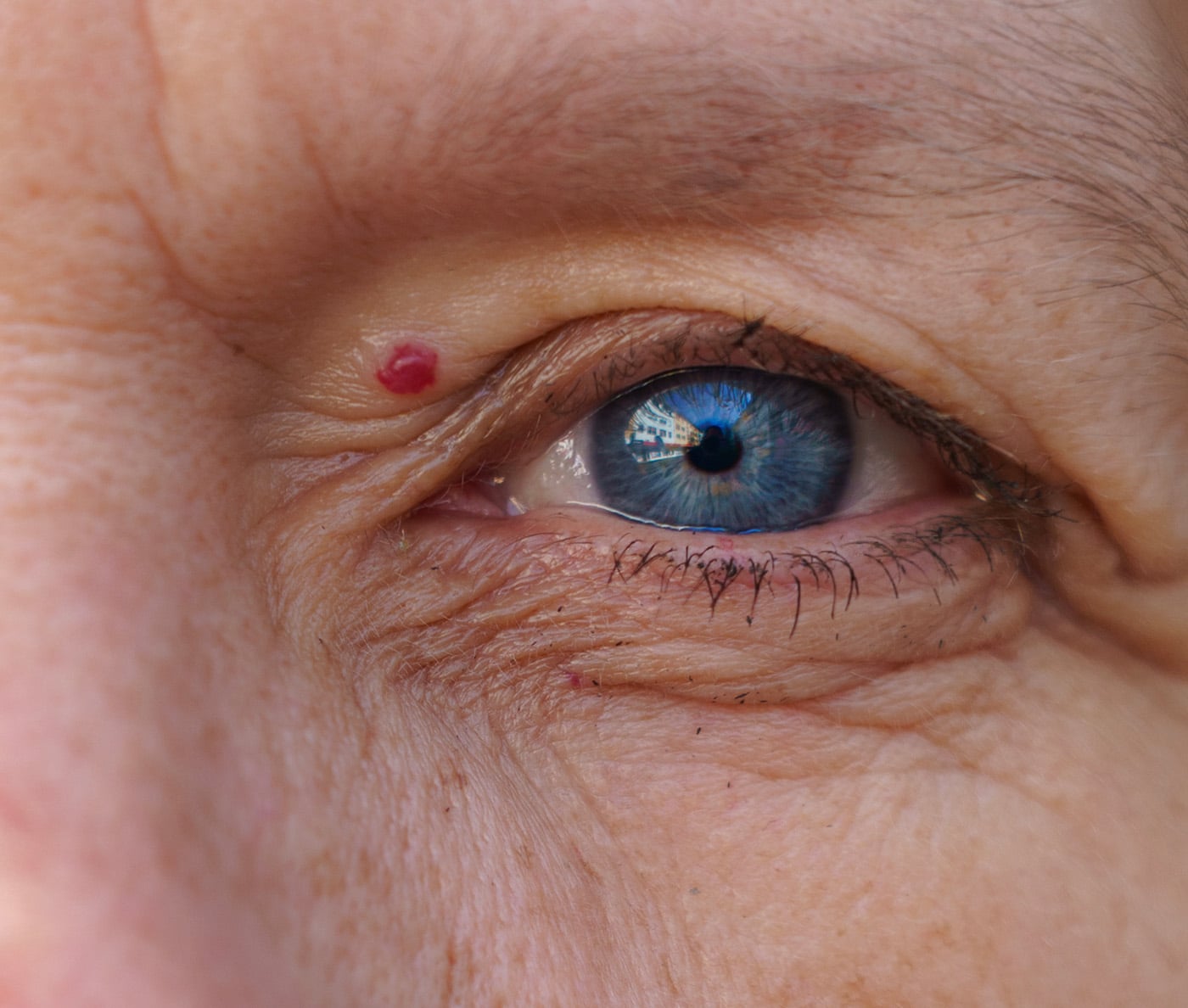 Angiome rubis visage à Paris | Traitement laser angiome stellaires | Clinique esthétique | Skin Marceau