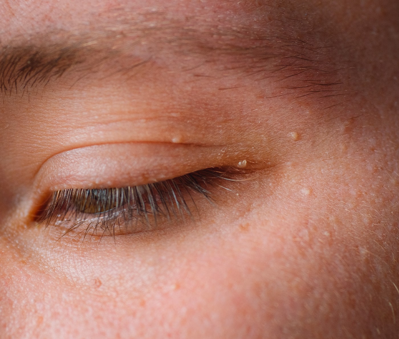 Lipome : causes et traitements, Clinique Skin Marceau