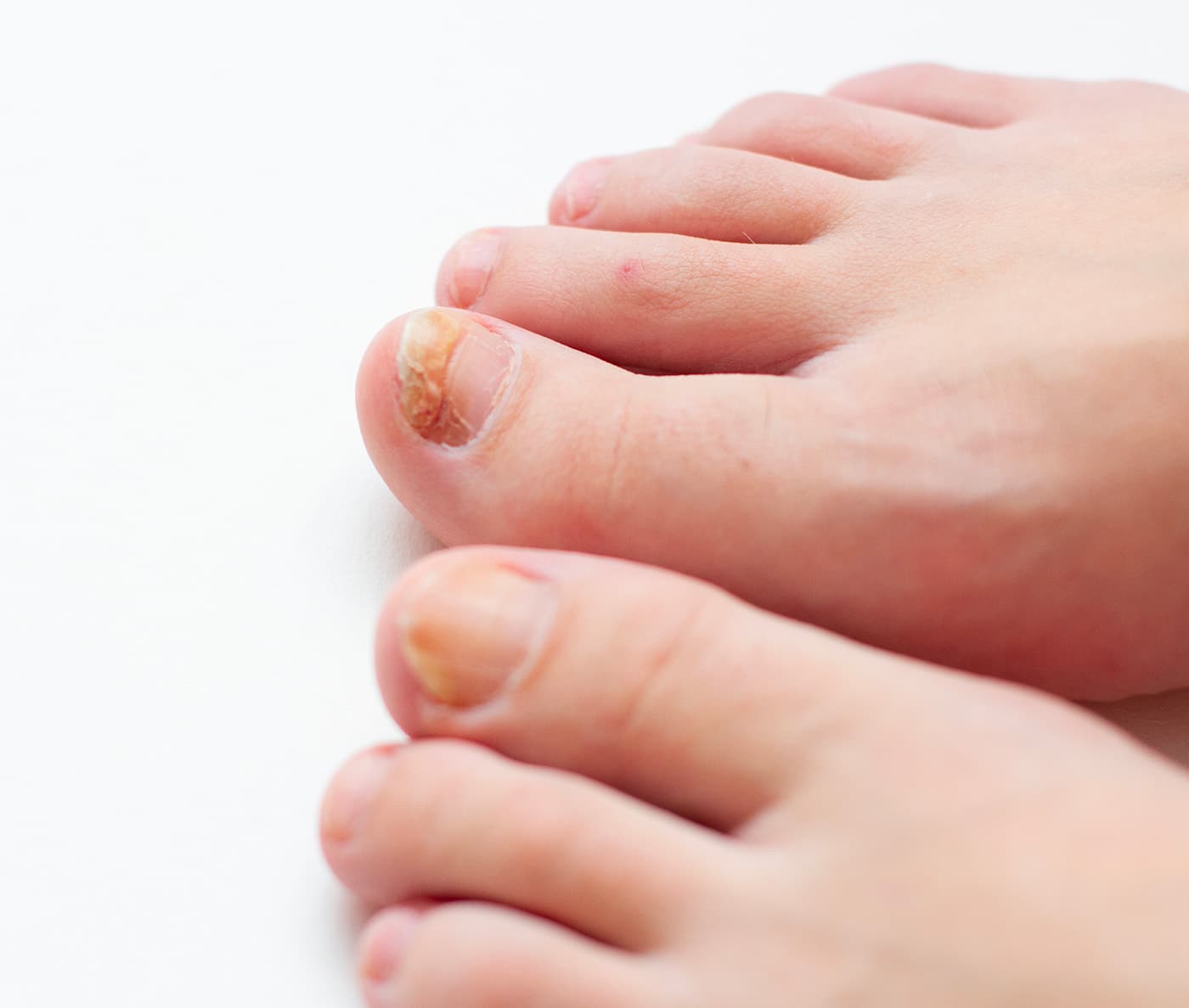 Fungal Toenail: Symptoms, Causes & Treatment | The Foot Hub