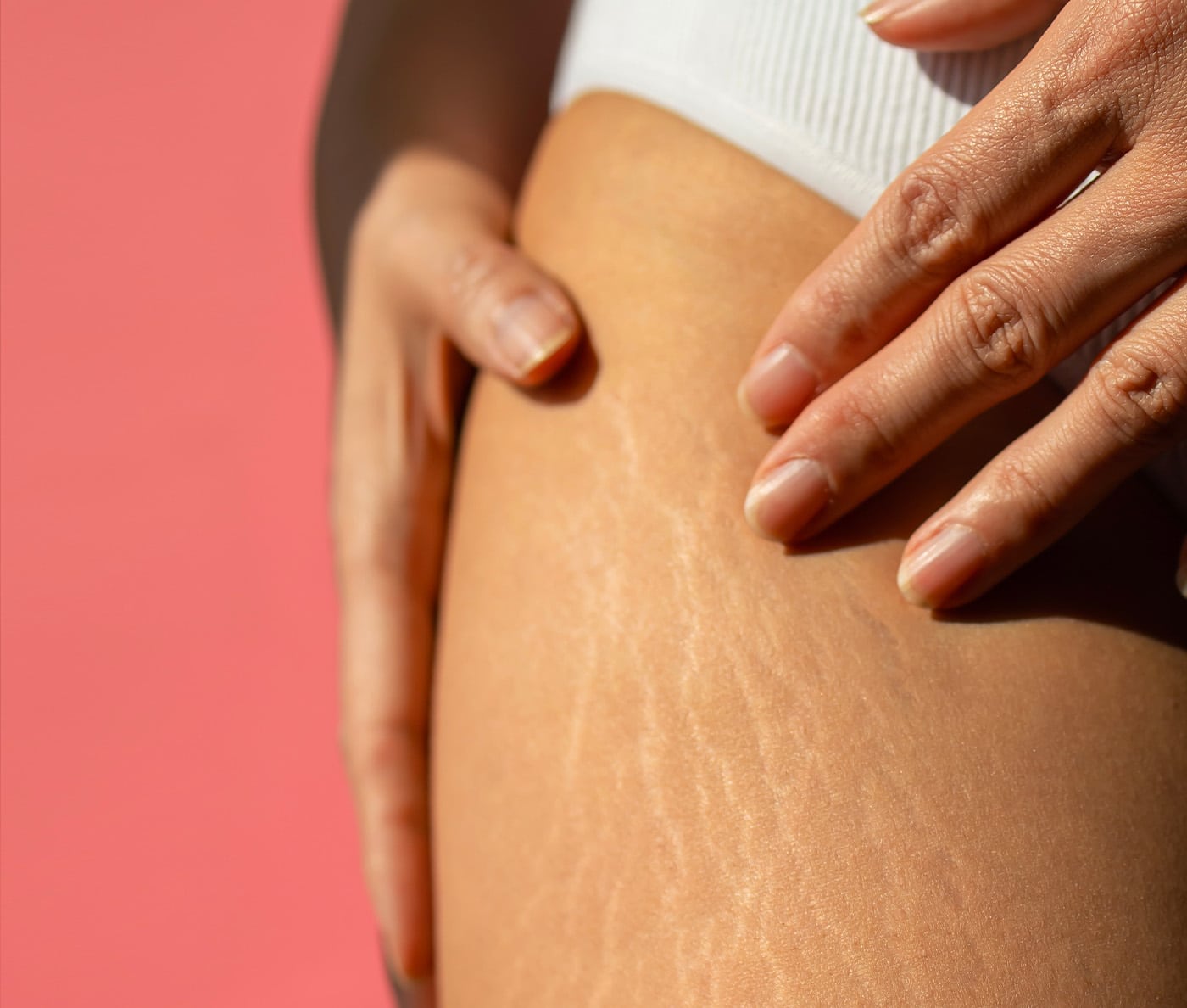 Stretch Marks: Causes and Treatments, Skin Marceau Clinic
