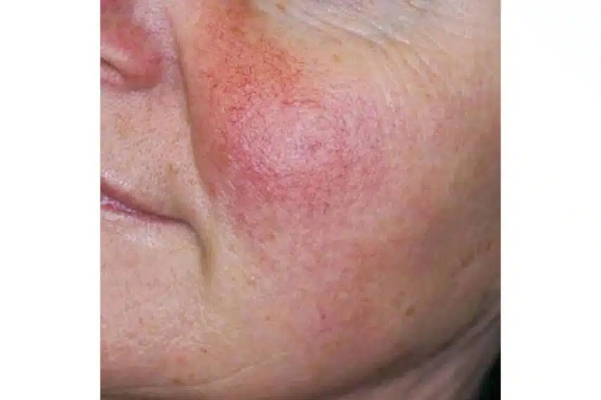 couperose laser - avant