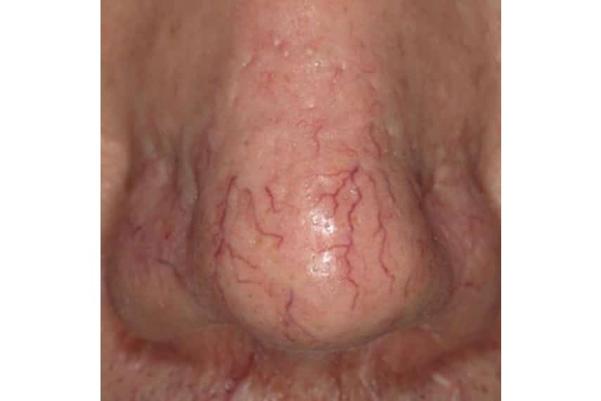 Les varicosités : causes et traitements | Clinique Skin Marceau ...