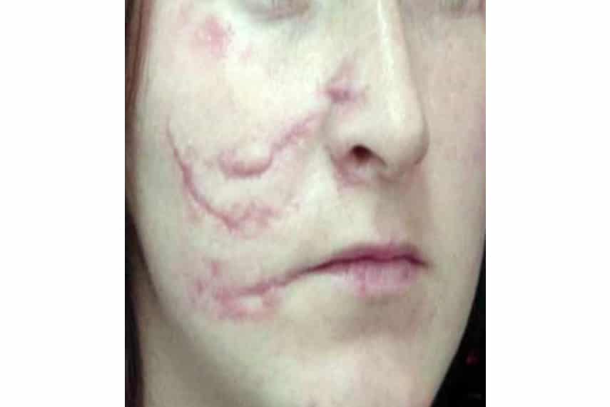 Les cicatrices : causes et traitements | Clinique Skin Marceau | Paris