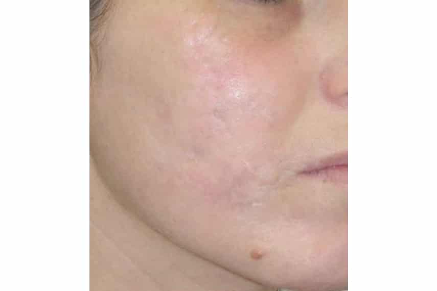 Traitement des cicatrices d'acné au laser à Paris | Dermatologue ...