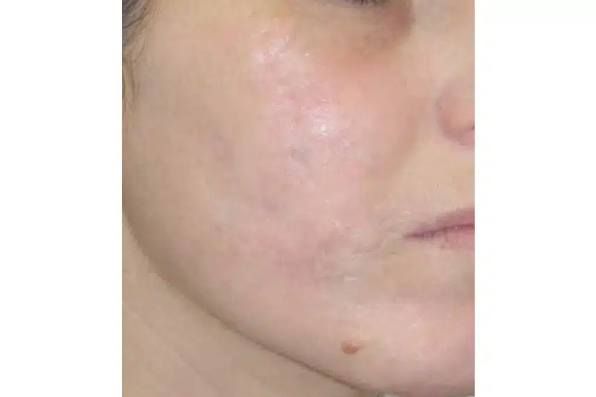 cicatrice acné laser avant apres