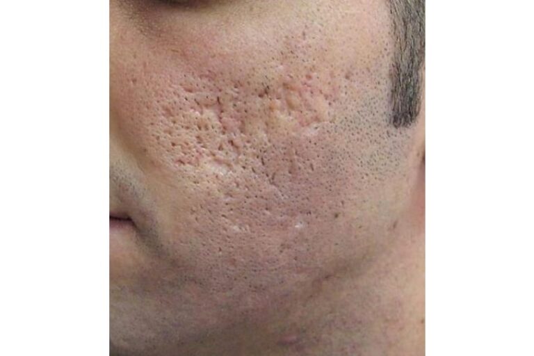 Traitement des cicatrices d'acné au laser à Paris Dermatologue Skin — free download