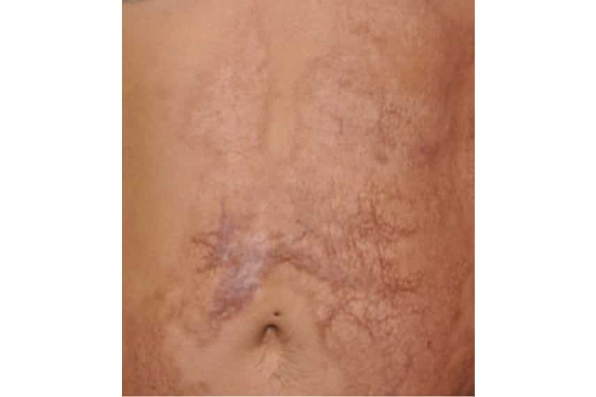 Les cicatrices : causes et traitements | Clinique Skin Marceau | Paris