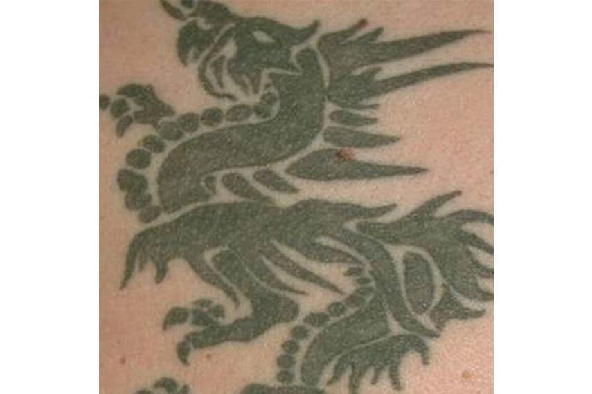 Tattoo removal program gives ex-cons new start