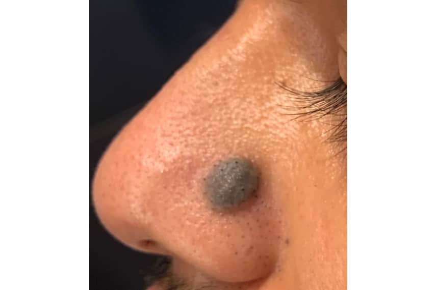 Enlever les grains de beauté au laser à Paris Dermatologue esthétique Skin Marceau