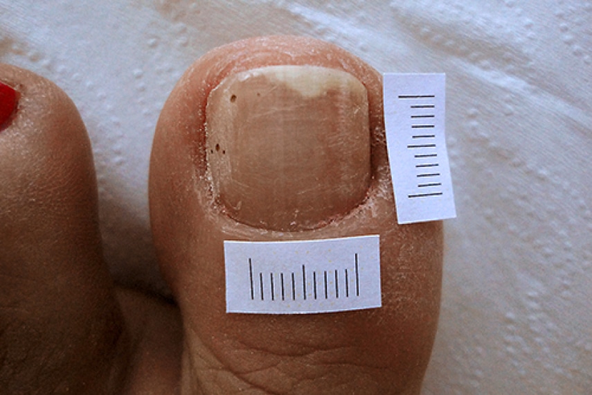 Mycose ongle pied – après traitement | Médecine esthétique | Clinique Skin Marceau Paris