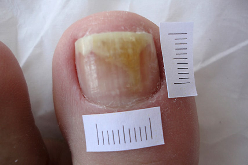 Mycose pied – infection fongique - avant traitement | Médecine esthétique | Clinique Skin Marceau Paris