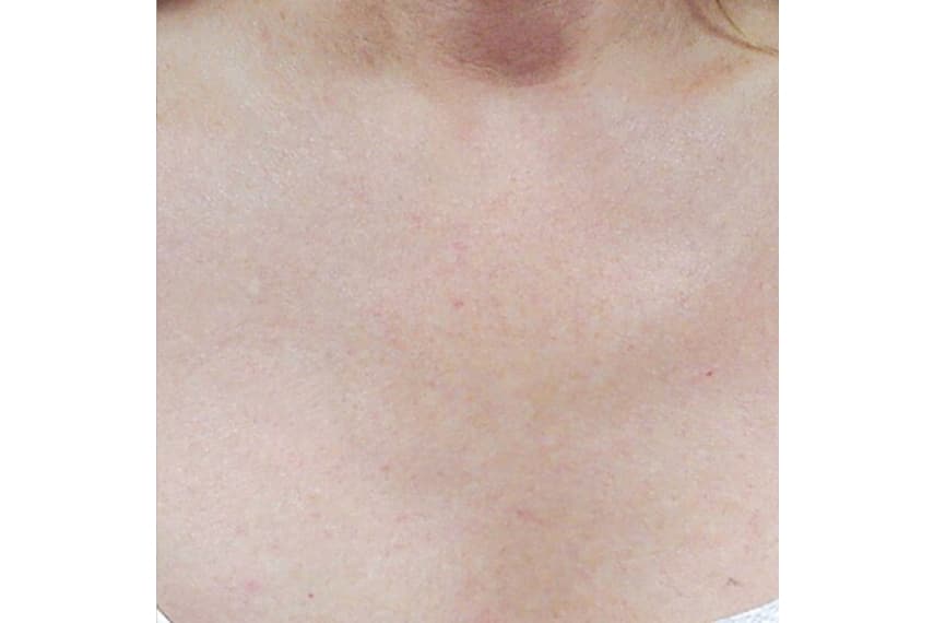 Taches pigmentaires traitement - Après | Médecine esthétique | Clinique Skin Marceau Paris