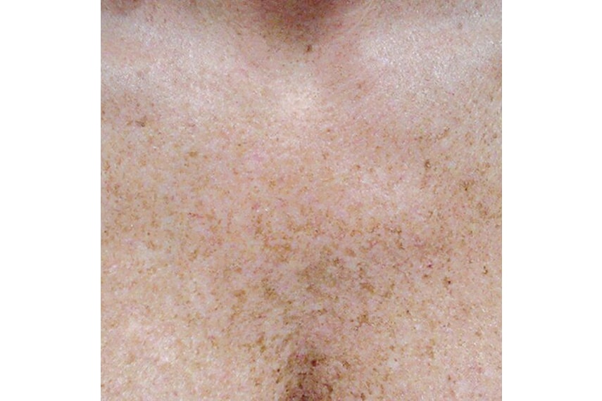 Laser pour enlever les taches brune - Avant | Médecine esthétique | Clinique Skin Marceau Paris