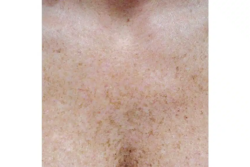 Laser pour enlever les taches brune - Avant | Médecine esthétique | Clinique Skin Marceau Paris