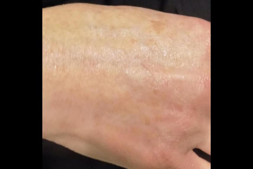 Traitement des taches brunes sur main - Après | Médecine esthétique | Clinique Skin Marceau Paris