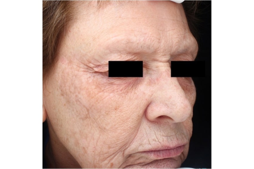 Traitement des taches brunes sur le visage - Après | Médecine esthétique | Clinique Skin Marceau Paris