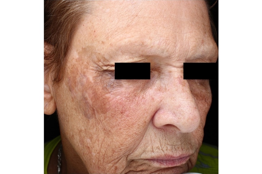 Taches brunes et laser visage - Avant | Médecine esthétique | Clinique Skin Marceau Paris