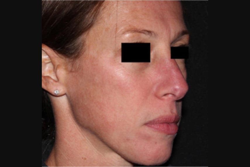 Laser hyperpigmentation peau visage - Après | Médecine esthétique | Clinique Skin Marceau Paris