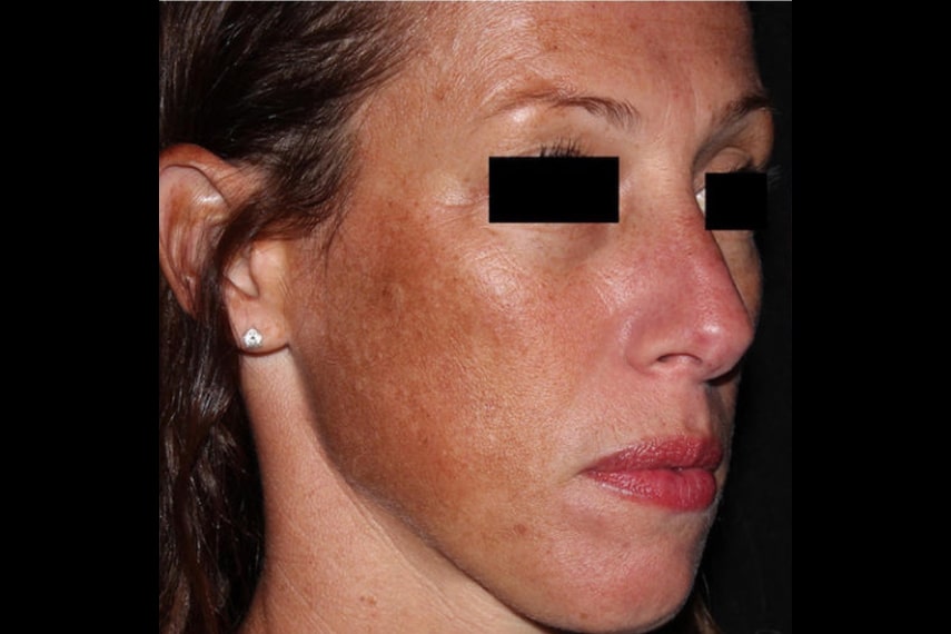 Laser visage tache brune - Avant | Médecine esthétique | Clinique Skin Marceau Paris