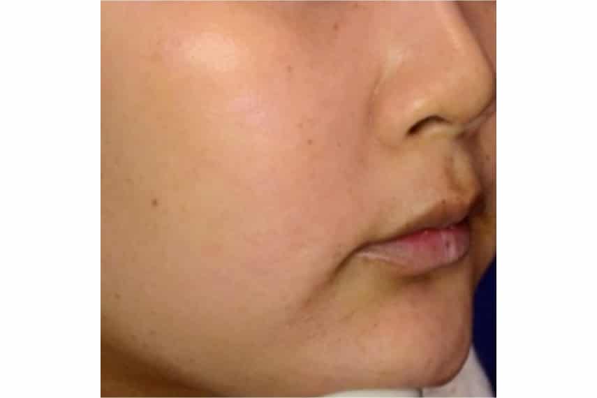 Lipome : causes et traitements, Clinique Skin Marceau