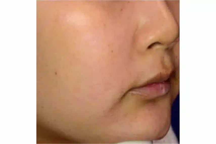 Traitement taches brunes visage - Après | Médecine esthétique | Clinique Skin Marceau Paris