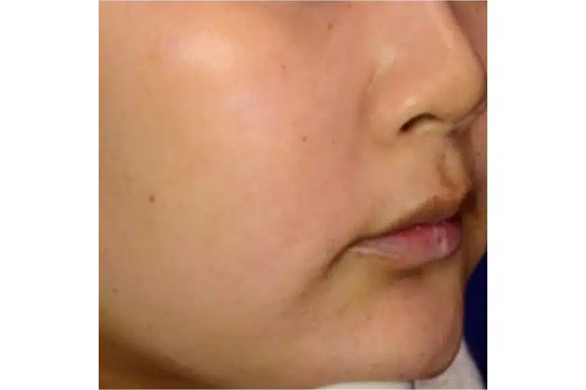 Traitement taches brunes visage - Après | Médecine esthétique | Clinique Skin Marceau Paris