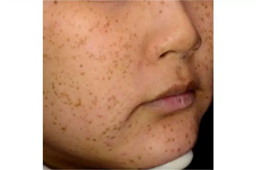 Taches brunes et laser visage - Avant | Médecine esthétique | Clinique Skin Marceau Paris