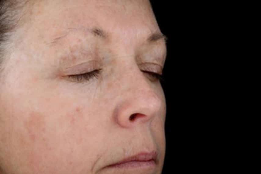 Laser pigmentaire visage tache brune - Après | Médecine esthétique | Clinique Skin Marceau Paris