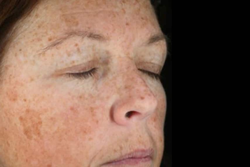 Taches brunes visage traitement - Avant | Médecine esthétique | Clinique Skin Marceau Paris