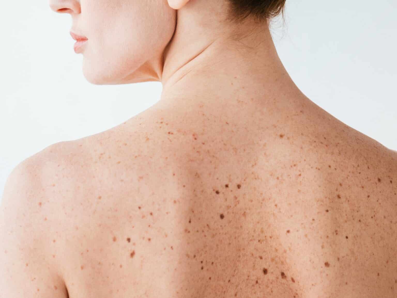 Enlever les grains de beauté au laser à Paris Dermatologue esthétique Skin Marceau