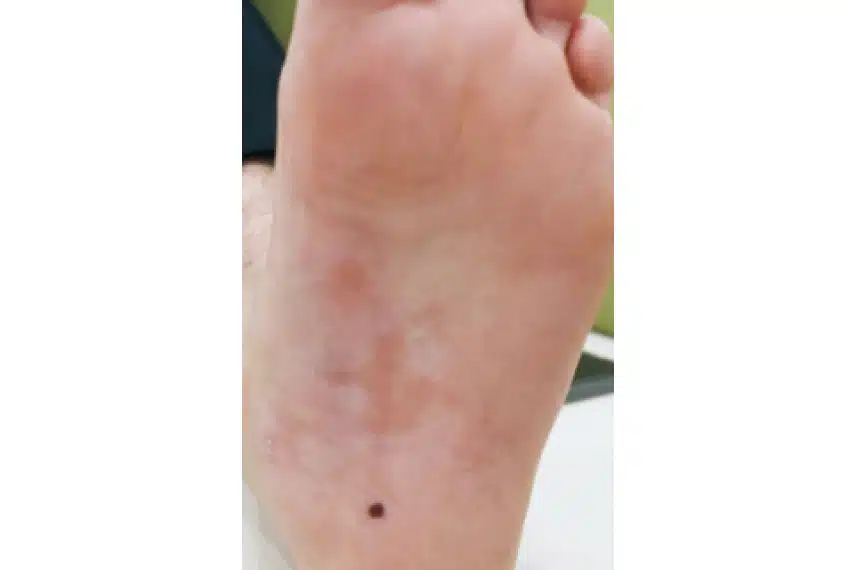 Traitement dermato verrue - Après | Médecine esthétique | Clinique Skin Marceau Paris