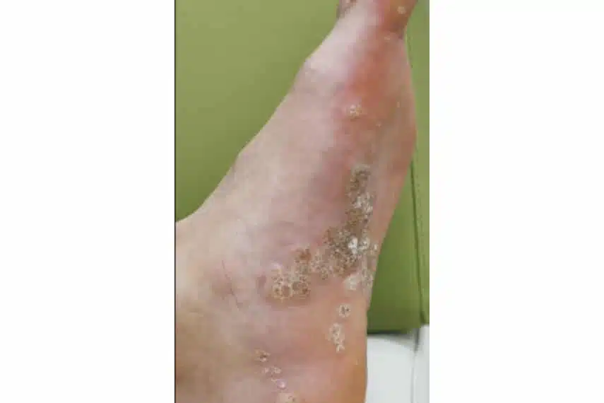 Verrues plantaires - Avant | Médecine esthétique | Clinique Skin Marceau Paris