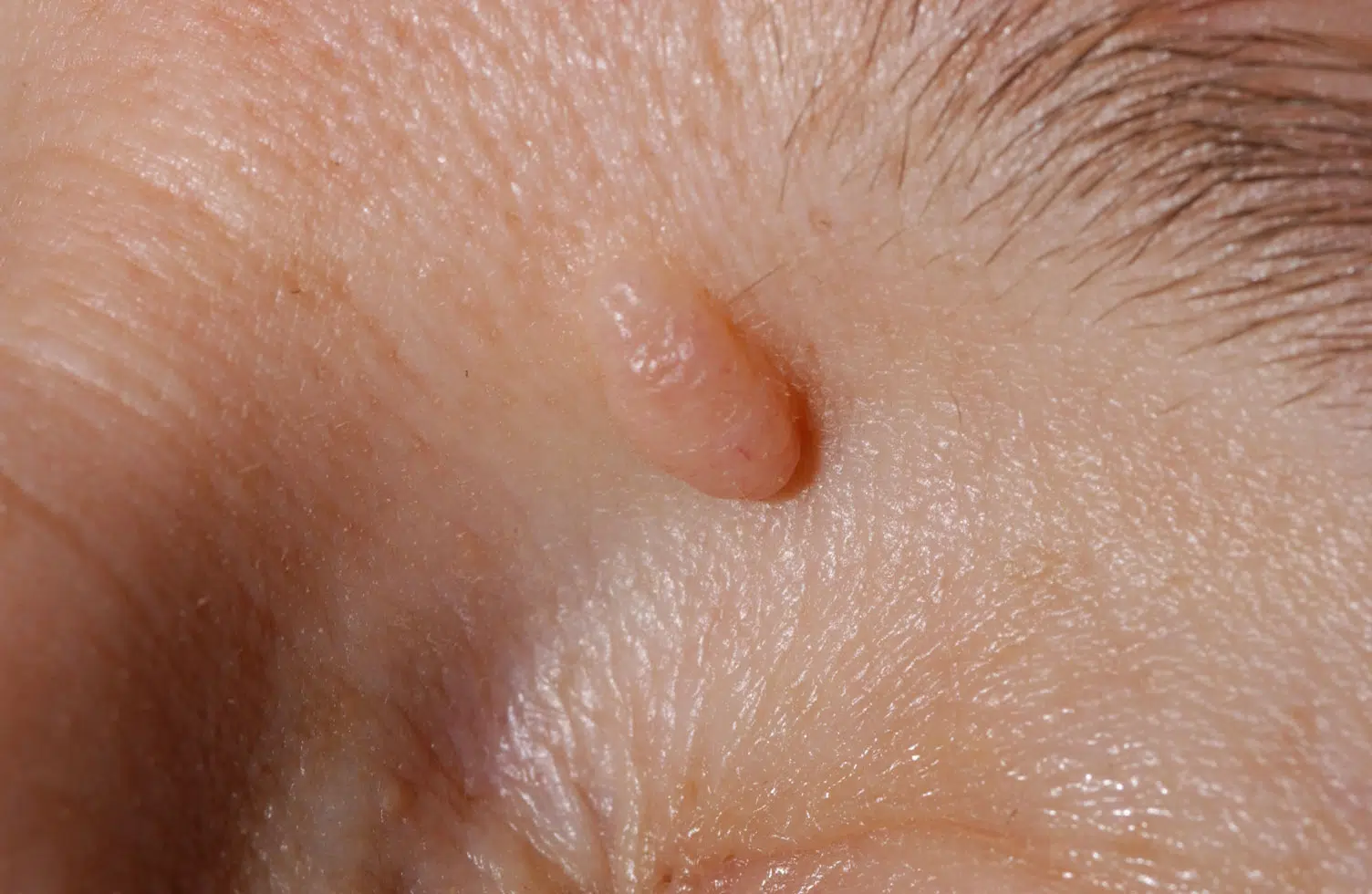 naevus-dermique-naevi-dermal