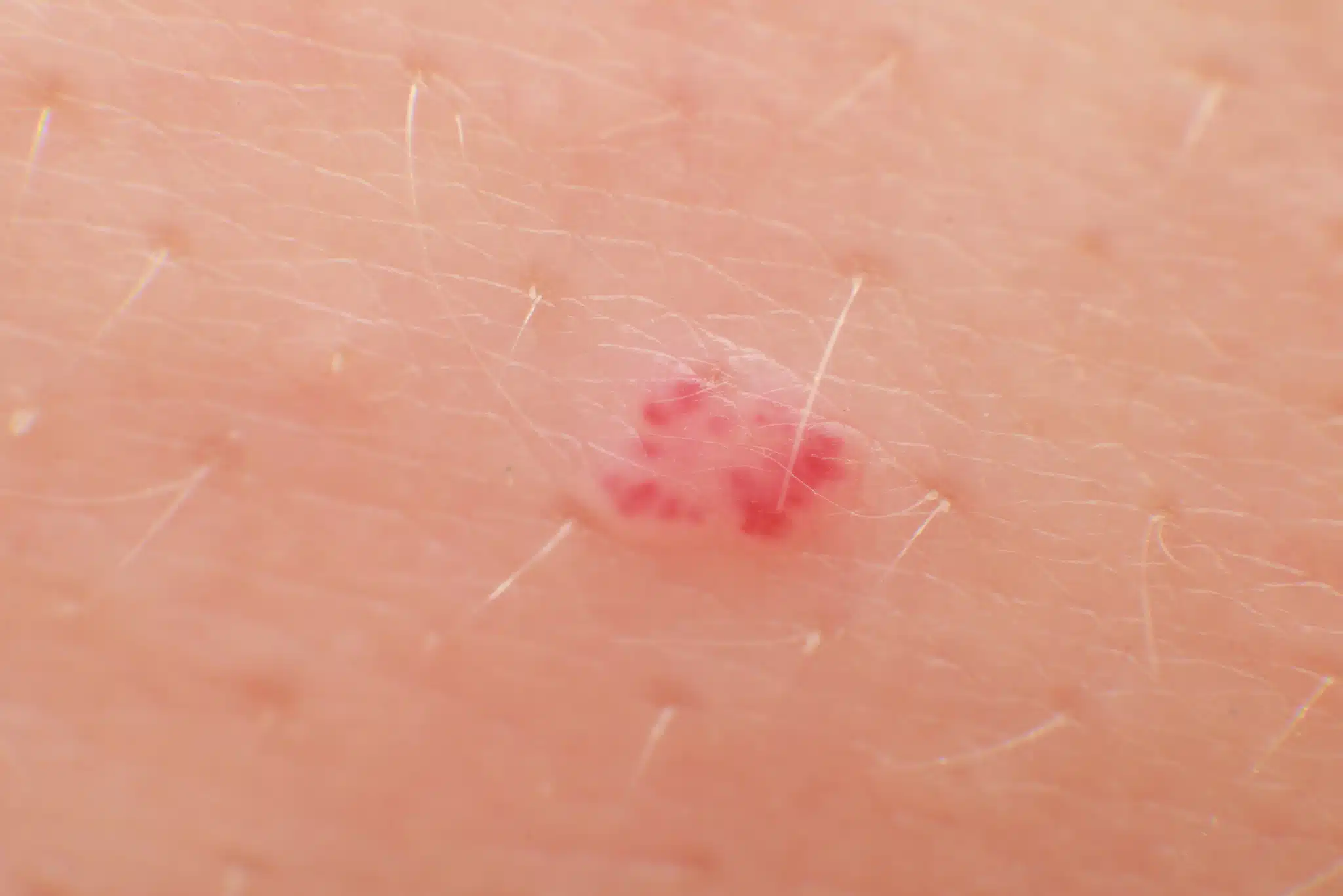 angiome rubis macro
