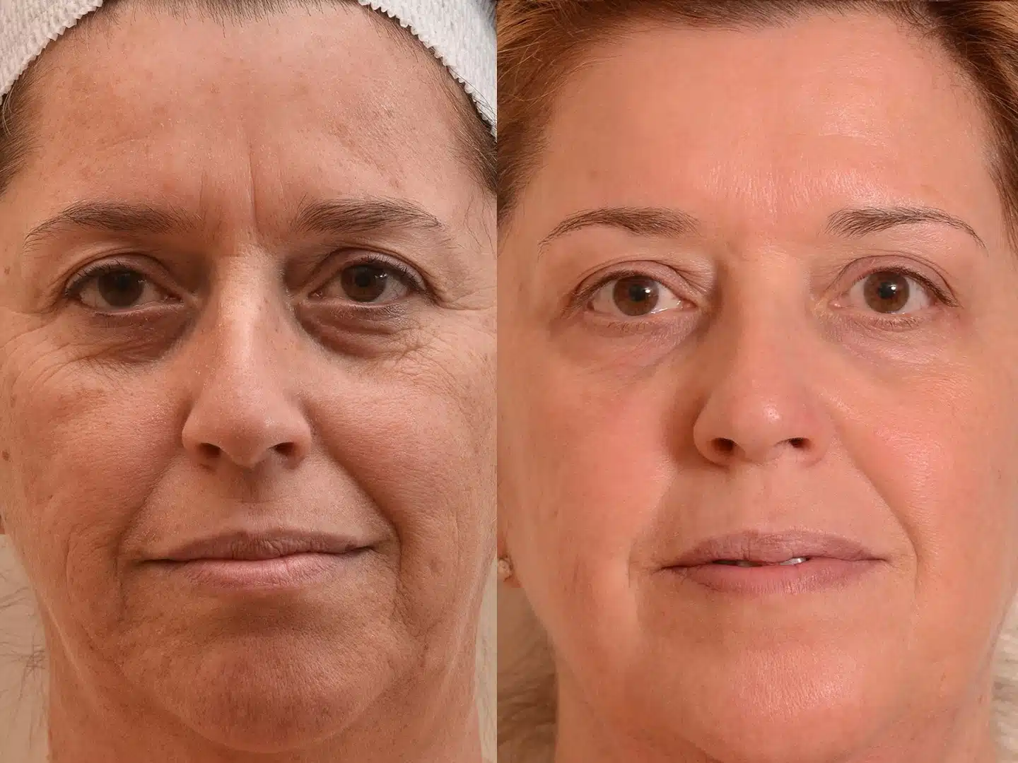 laser CO2 fractionné avant après Skin Marceau Paris