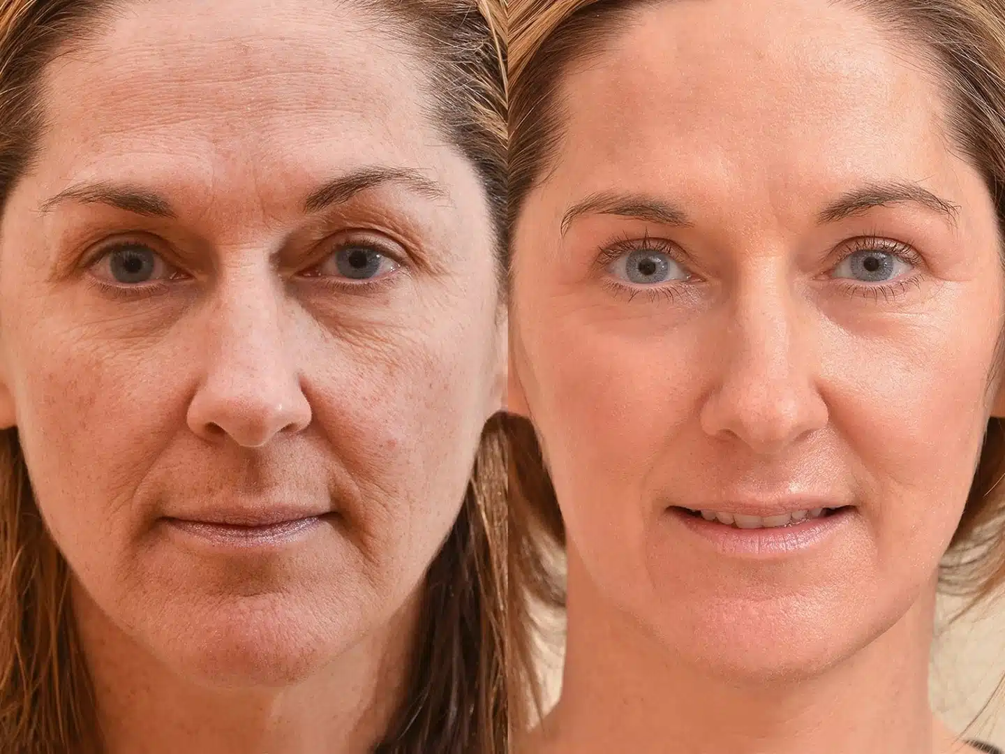 laser CO2 ablatif avant après Skin Marceau Paris