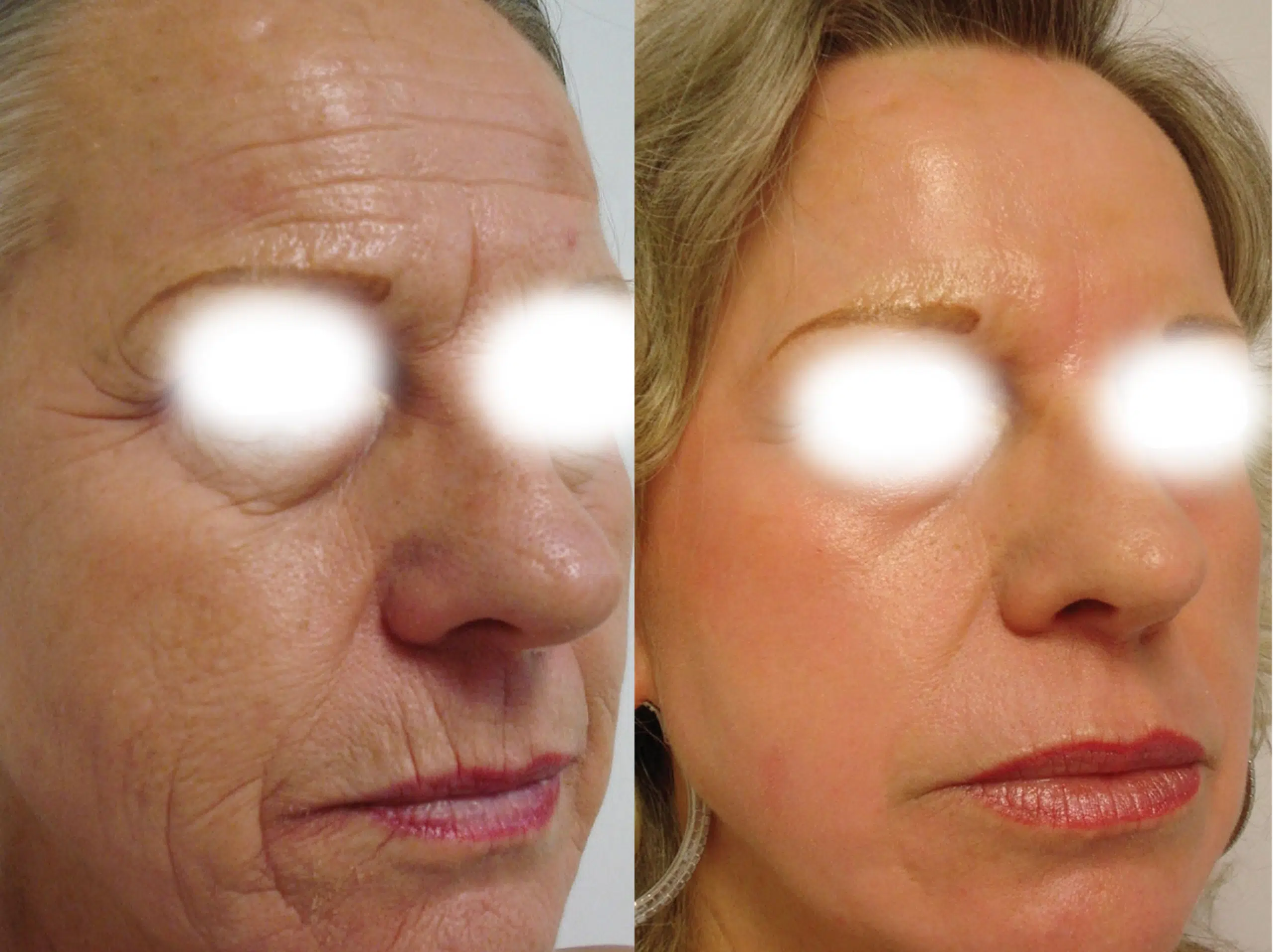 laser CO2 fractionné avant après Skin Marceau Paris