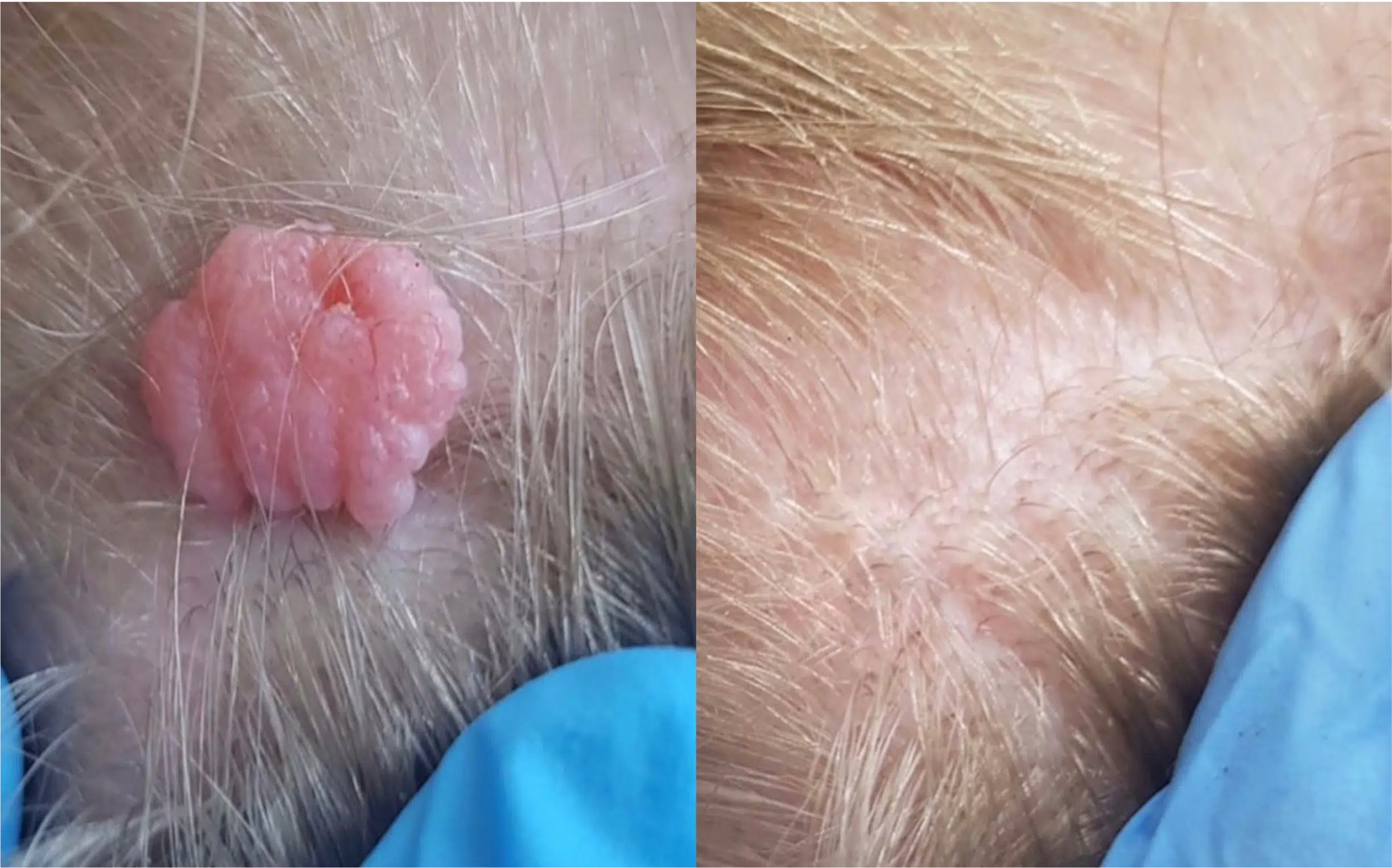 avant après acorchordons excroissance de peau skin marceau traitement