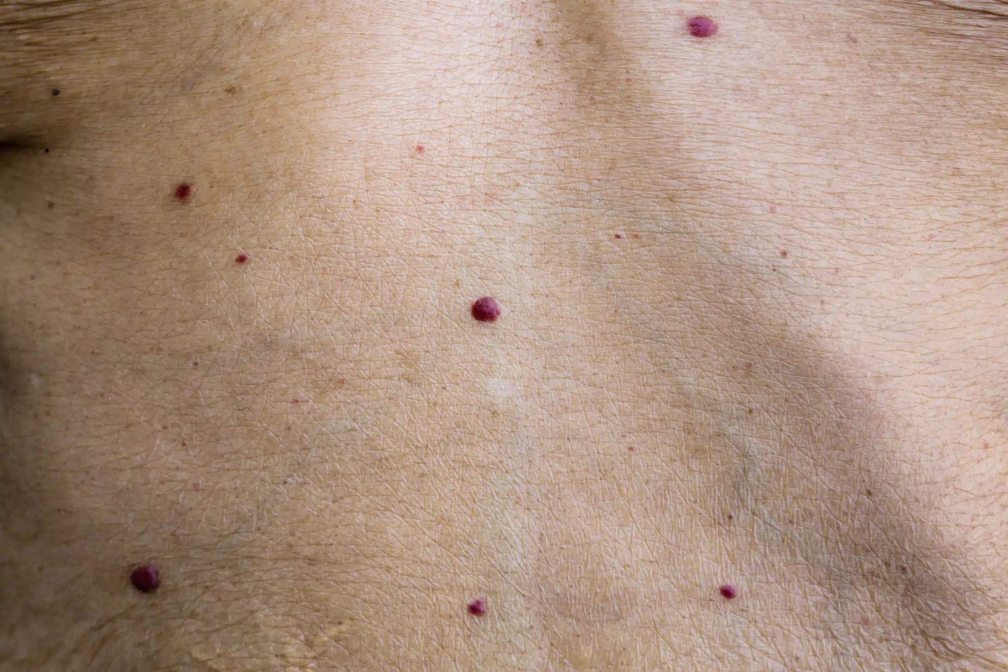 angiome rubis skin marceau paris dos
