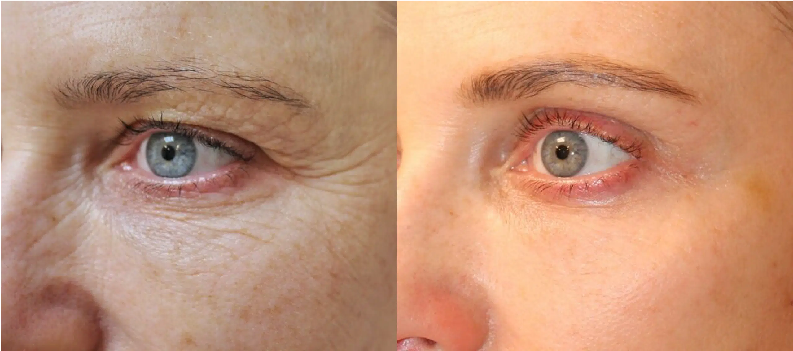 blepharoplastie lumenis ultrapulse alpha avant apres