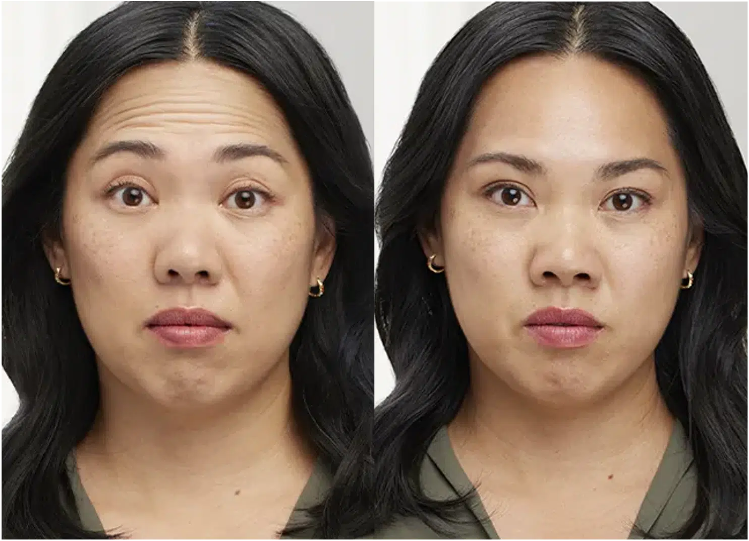 botox avant après