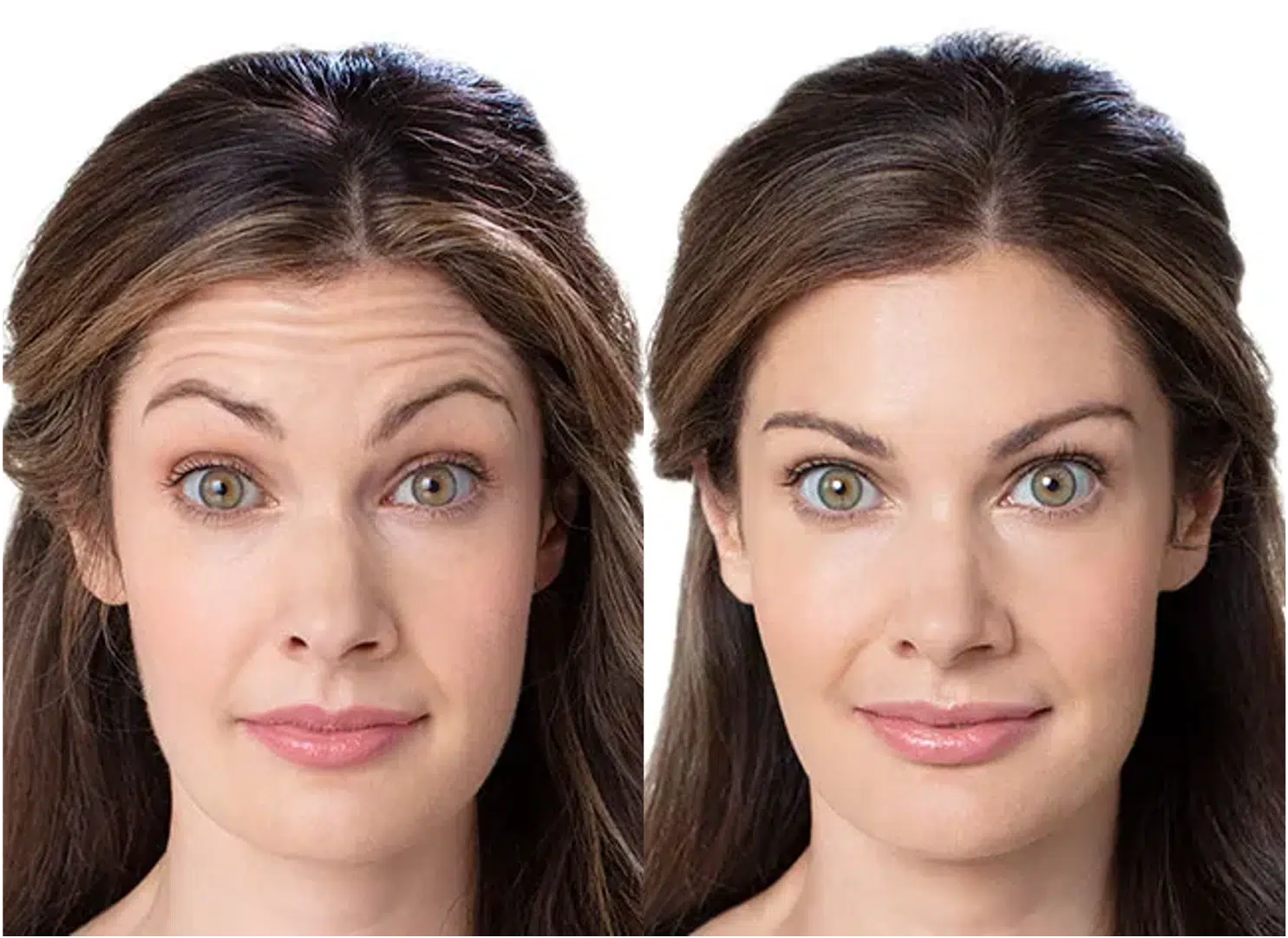 botox avant après