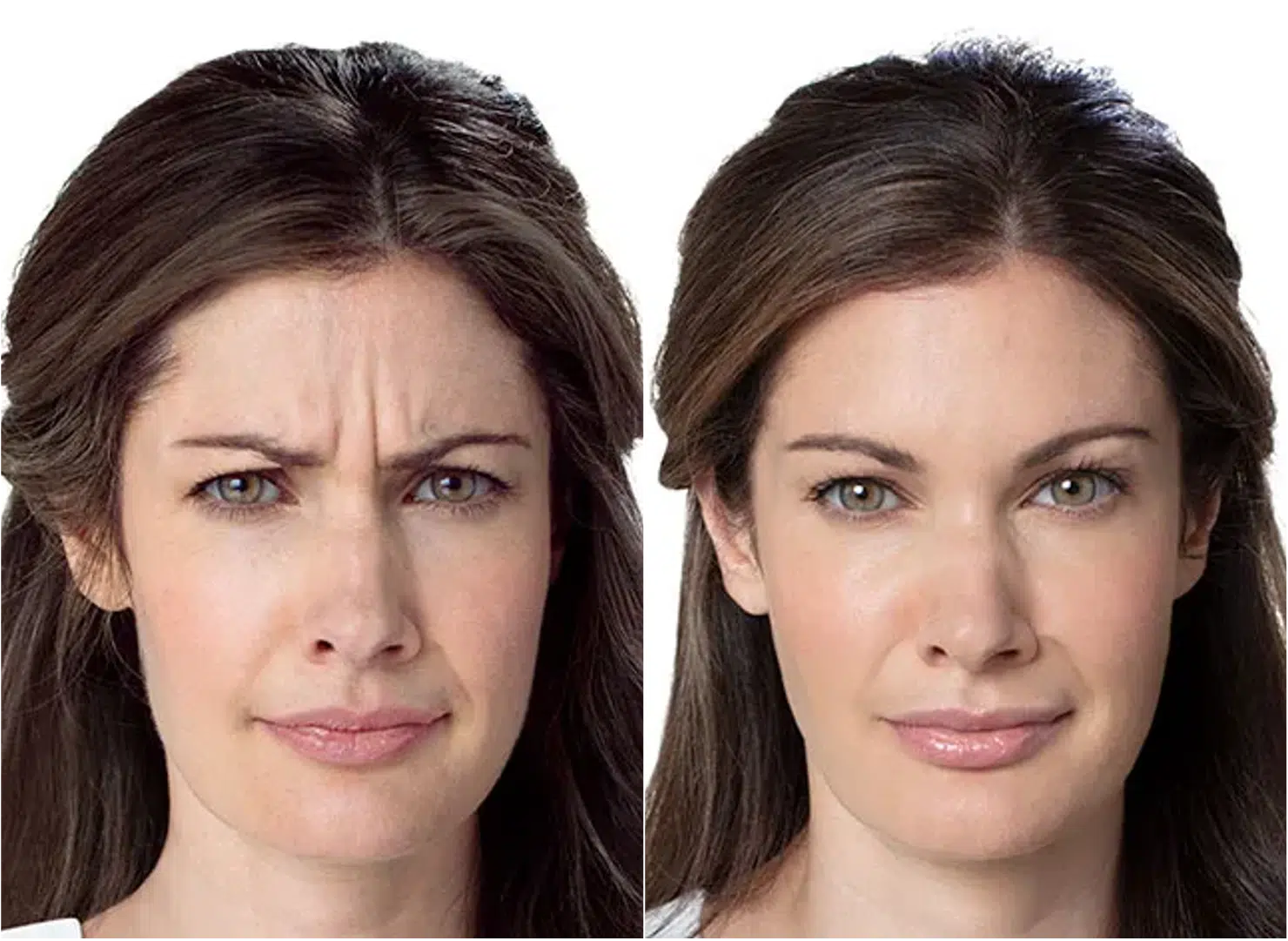 botox avant après