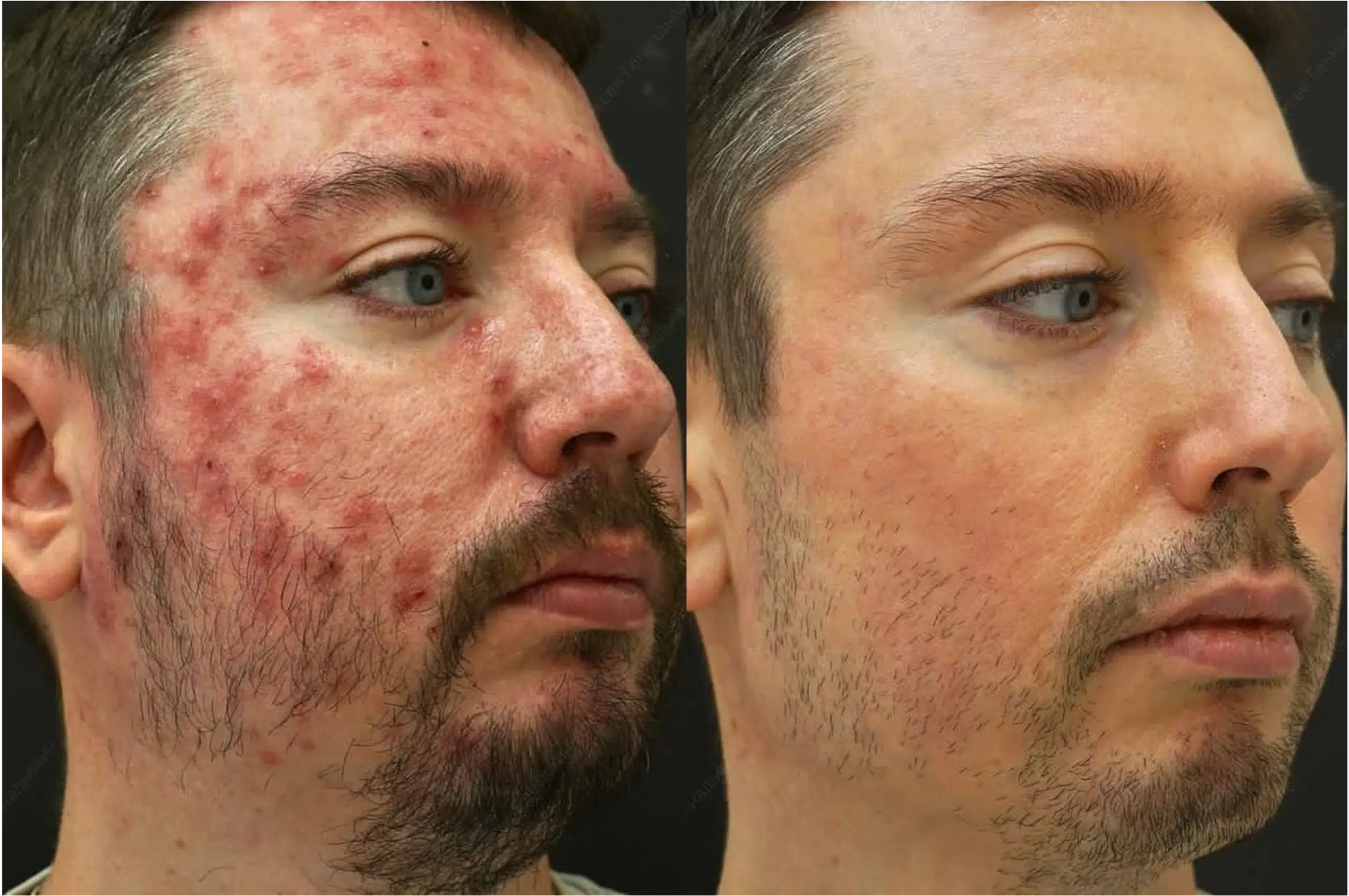 Couperose laser avant après