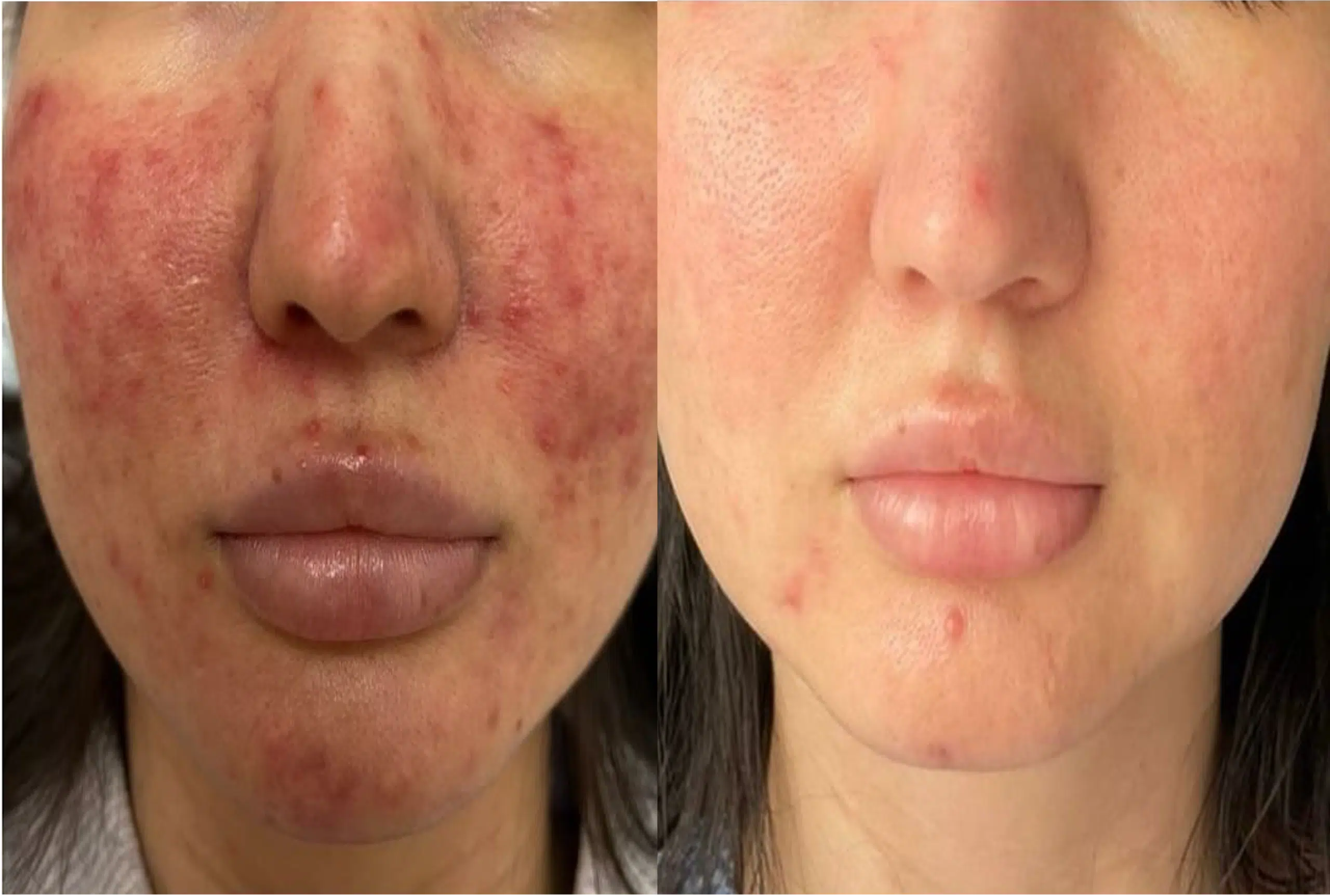Couperose laser avant après