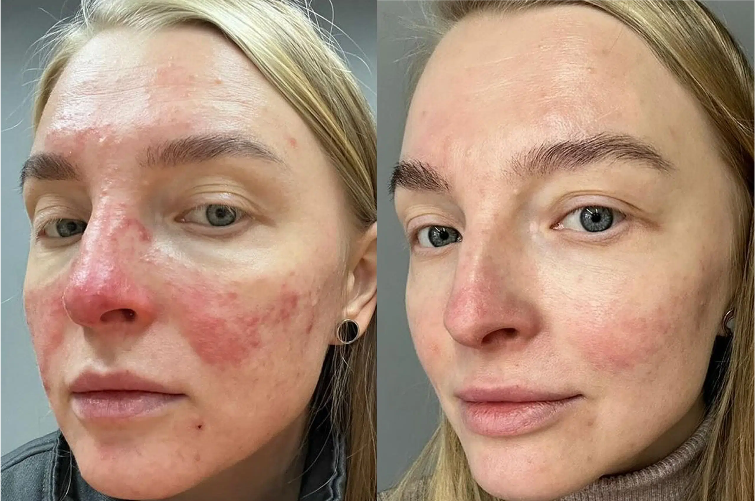 Couperose laser avant après