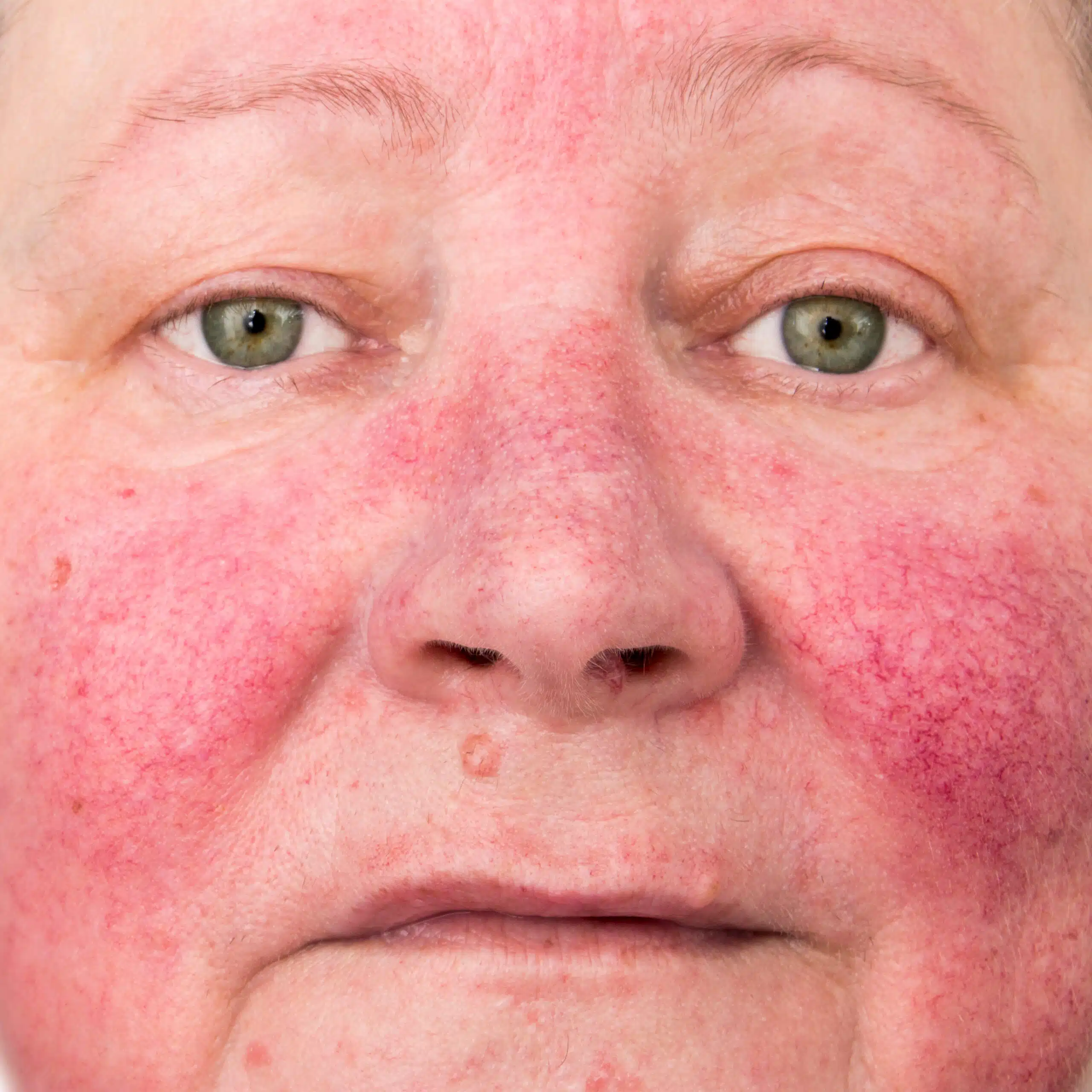 Rosacée visage Skin Marceau Paris