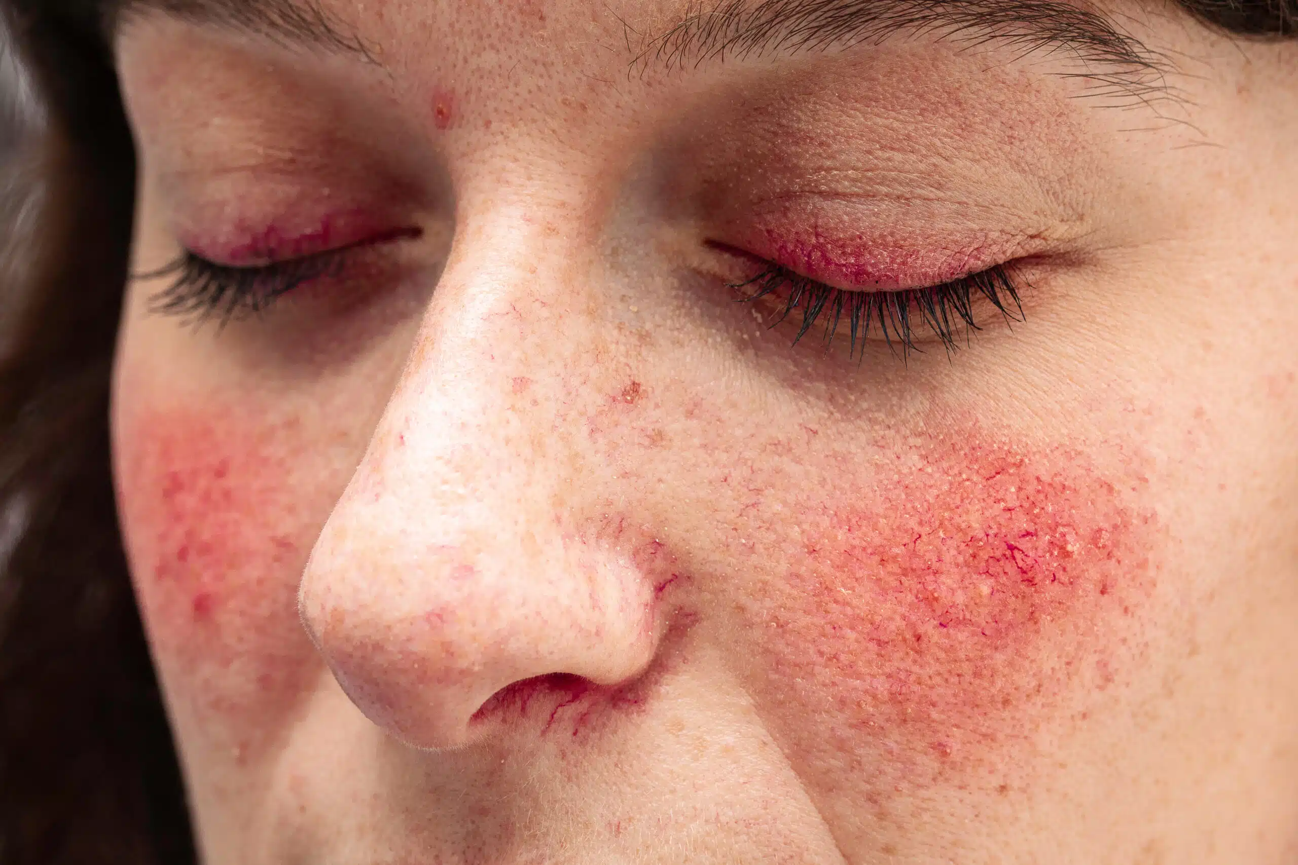 Rosacée visage Skin Marceau Paris